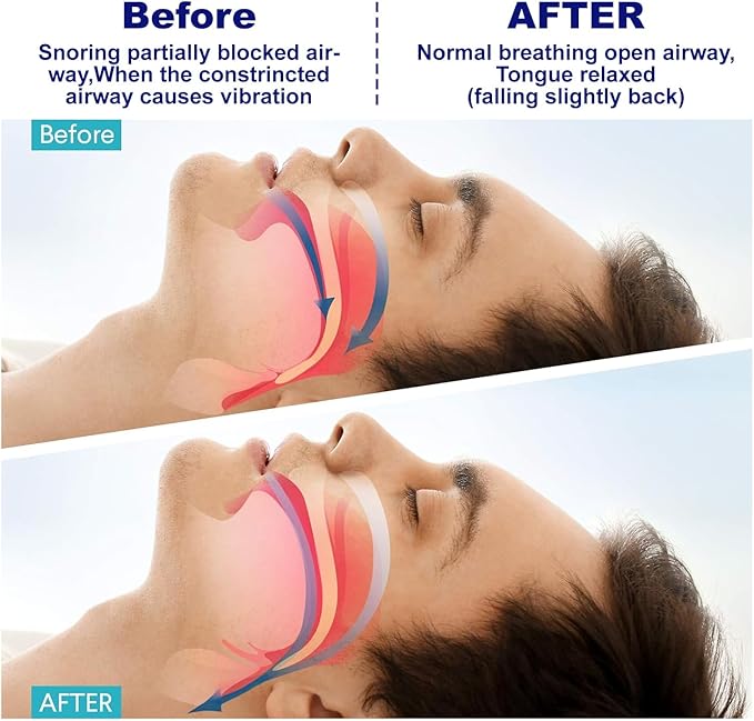 π΄ Adjustable Anti-Snoring & Teeth Grinding Mouthguard β Sleep Better, Wake Refreshed! π΄
