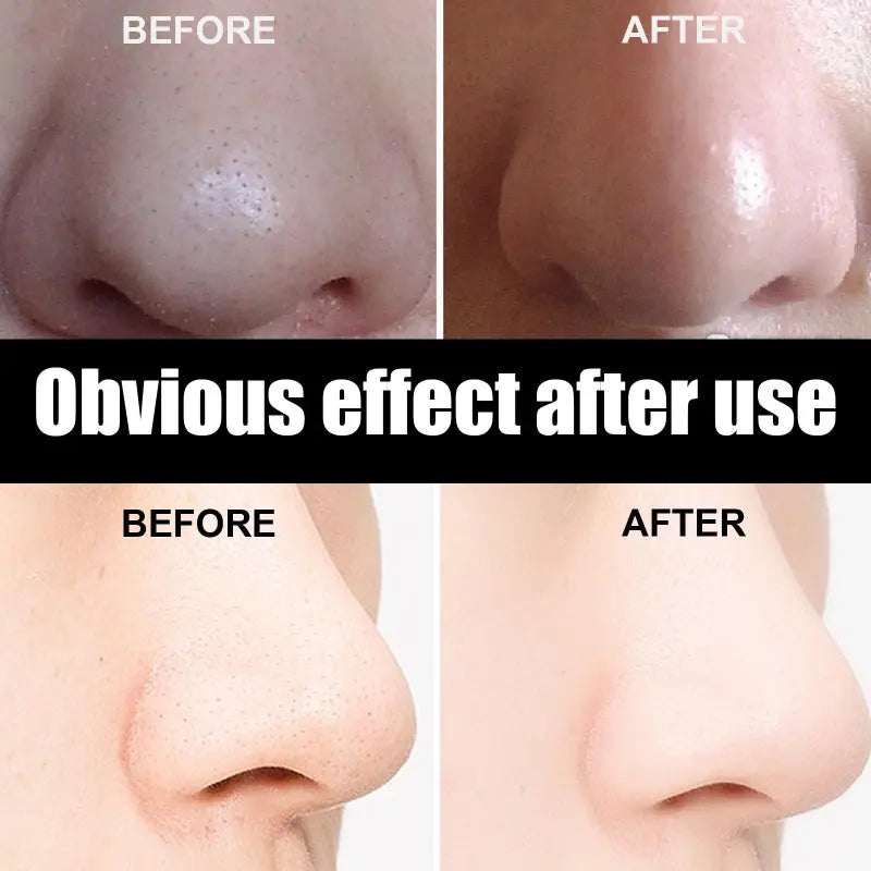 DeepClean Blackhead Remover Strips (20pcs)