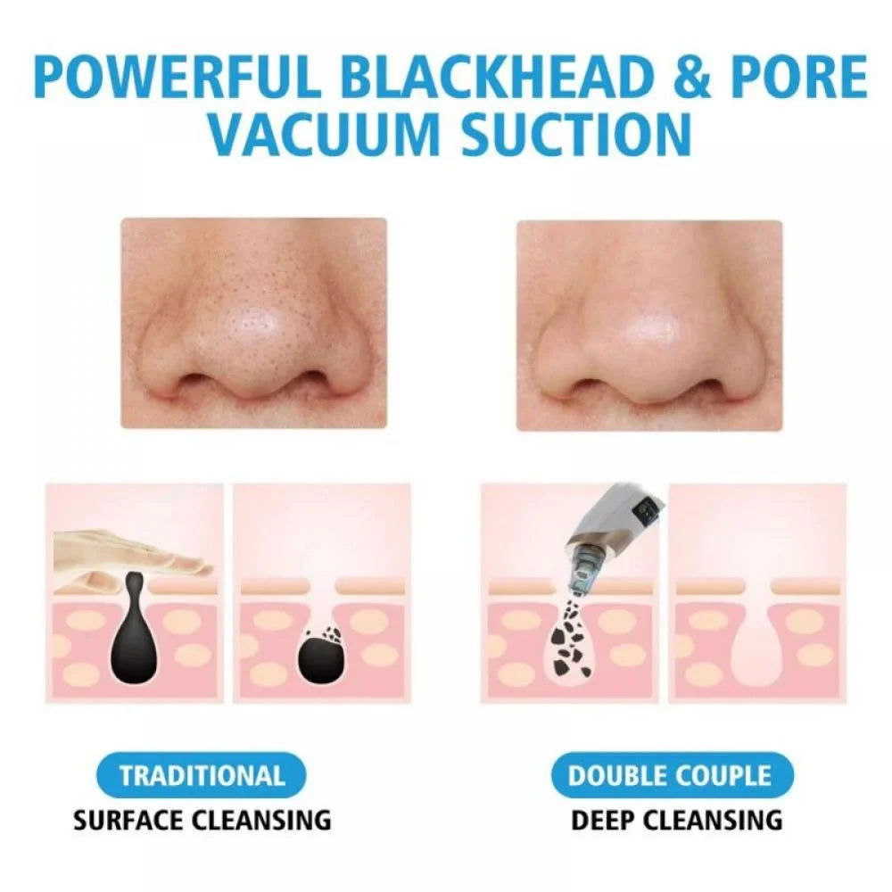 🌟 Electric Blackhead Remover – Instantly Clear Your Skin! 🌟