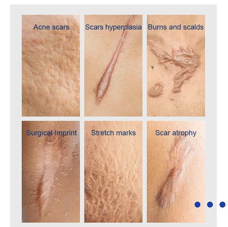 ✨ Scar Removal Cream – Advanced Repair for Flawless Skin! ✨