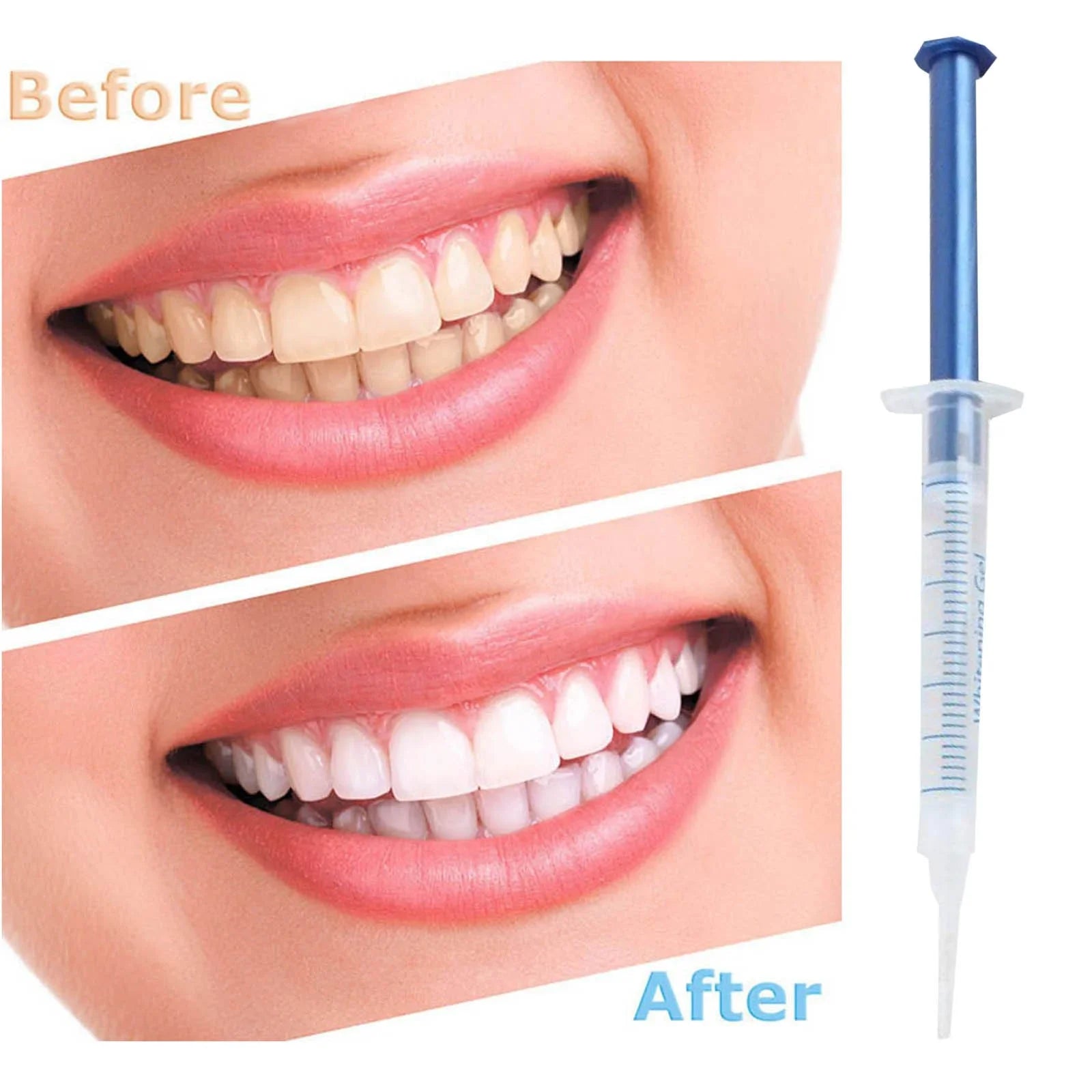 VitalSmyle™ Bright Teeth Whitening Kit – The #1 Choice for a Radiant Smile